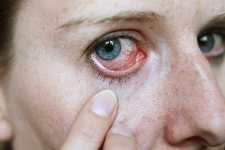 Herpes Ocular